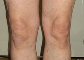 Nach einem Zyklus der Osteflex-Anwendung normalisieren sich die Gelenke wieder.